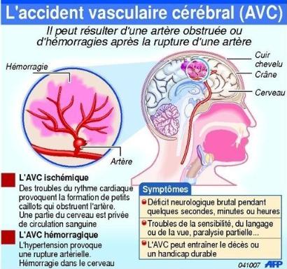 accident vasculaire cérébral